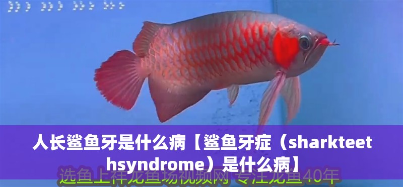 人長(zhǎng)鯊魚(yú)牙是什么病【鯊魚(yú)牙癥（sharkteethsyndrome）是什么病】