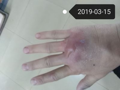 魟魚刺傷后的癥狀有哪些表現：魟魚刺傷后的癥狀 魟魚刺傷后的癥狀有哪些表現：魟魚刺傷后的癥狀 魟魚百科 第4張