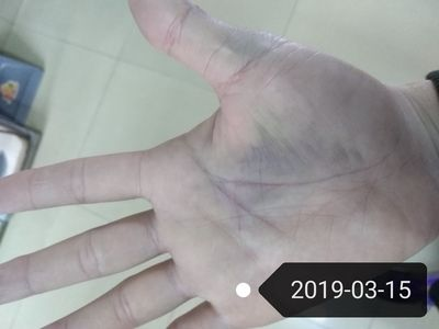 被魟魚刺到會怎么樣：被魟魚刺到可能會導(dǎo)致一系列嚴(yán)重的健康問題