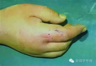 魟魚外傷：魟魚外傷處理方法