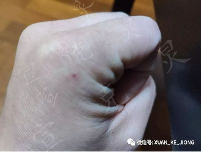 魟魚刺傷后怎么治療：魟魚刺傷后怎么治療[需手動填充]魚刺傷后的治療方法主要包括以下幾個方面 魟魚刺傷后怎么治療：魟魚刺傷后怎么治療[需手動填充]魚刺傷后的治療方法主要包括以下幾個方面 魟魚百科 第3張