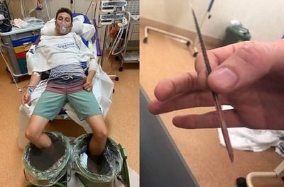 被魟魚刺到的人：被魟魚刺到的人會有怎樣的疼痛？