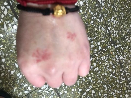 非手術療法能治愈龍魚鰓蓋圓坑嗎？，手術治療龍魚鰓蓋圓坑存在風險，手術后多久能恢復