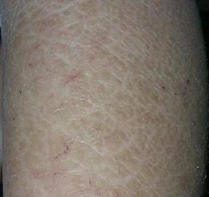 豎鱗病圖片，豎鱗病典型癥狀高清圖片 豎鱗病圖片，豎鱗病典型癥狀高清圖片 龍魚百科 第16張