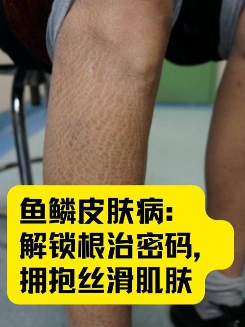 豎鱗病圖片，豎鱗病典型癥狀高清圖片 豎鱗病圖片，豎鱗病典型癥狀高清圖片 龍魚百科 第9張