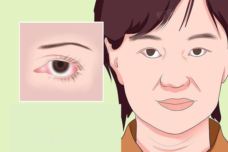 紅龍眼眼病最怕三個癥狀【民福康紅眼病的癥狀是什么】