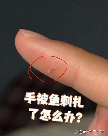 虎魚刺扎手了最怕三個東西