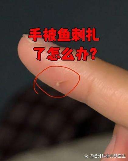 虎魚刺扎手了最怕三個東西