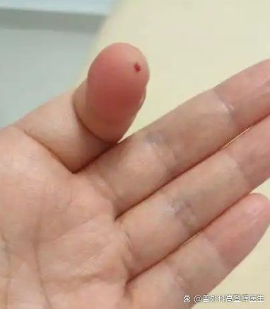虎魚刺扎手了最怕三個東西