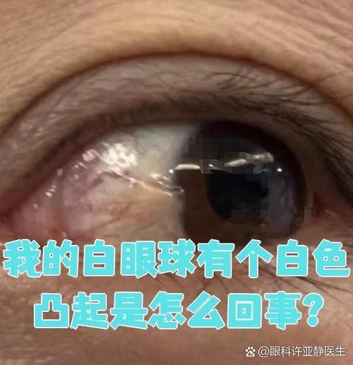 有沒有圖片展示龍眼白霧癥狀？