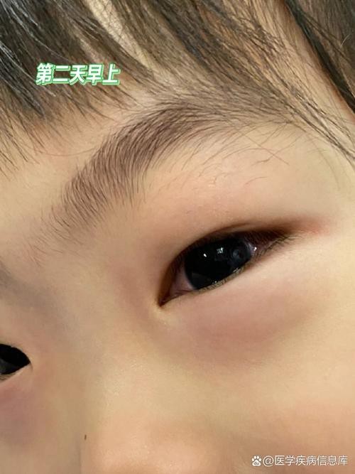 有沒有圖片展示龍眼白霧癥狀？