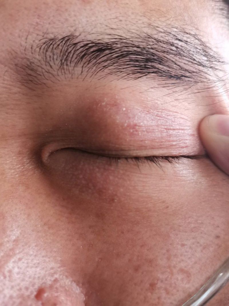 眼皮內側小白點可以擠破嗎？