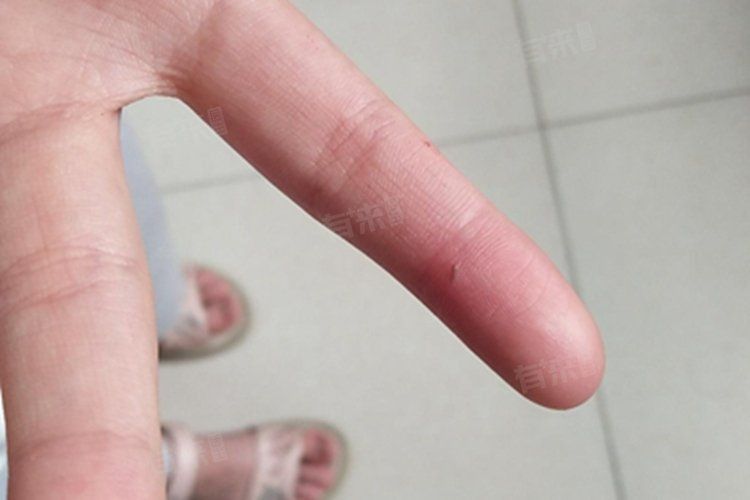 老虎魚(yú)扎到手會(huì)自愈嗎
