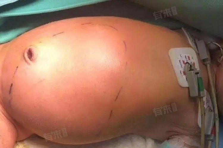 腹水病能自愈嗎？