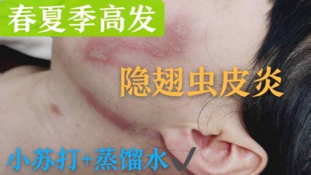 隱翅蟲皮炎如何治療？