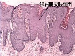 拔鱗手術(shù)的風(fēng)險有多大？