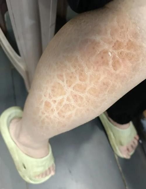 銀龍魚爛鱗怎么治療圖片大全圖解