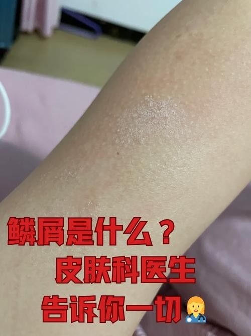銀龍魚爛鱗怎么治療圖片大全圖解