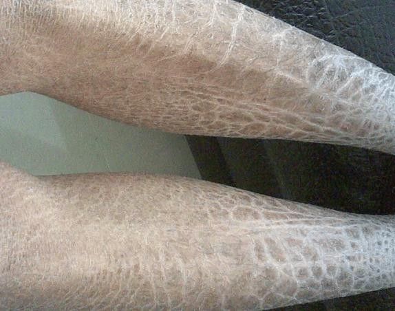 銀龍魚爛鱗怎么治療圖片大全圖解