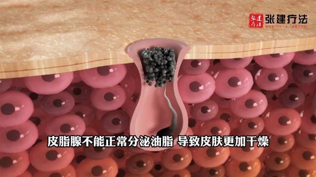 松鱗病一般多久能治愈？