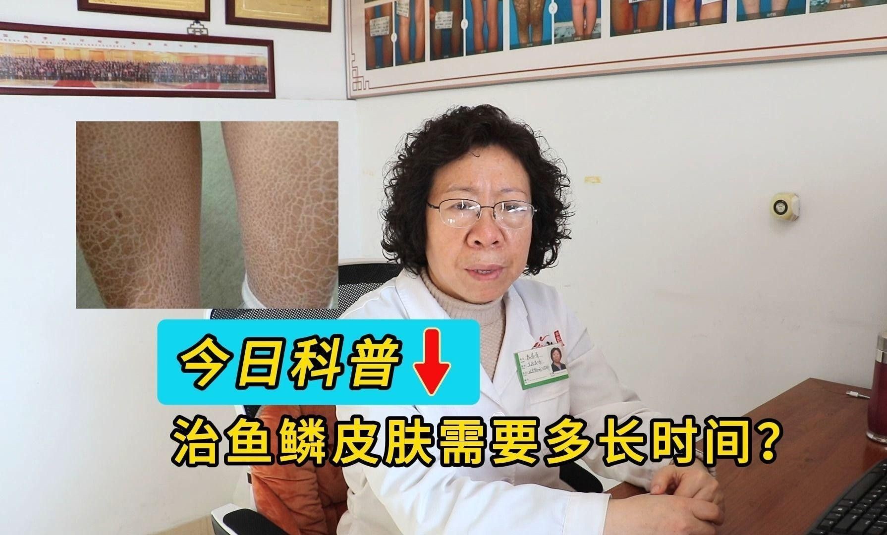 松鱗病一般多久能治愈？