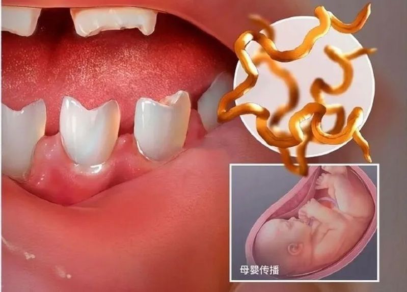 鋸齒牙和梅毒牙的區別