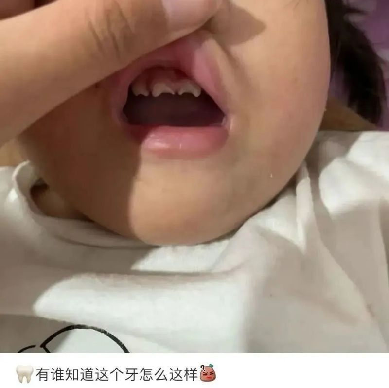 鋸齒牙和梅毒牙的區(qū)別