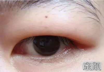 龍魚眼腫脹該怎么治療好：龍魚眼腫脹可能由多種原因引起，治療龍魚眼腫脹需綜合考慮多個因素 龍魚眼腫脹該怎么治療好：龍魚眼腫脹可能由多種原因引起，治療龍魚眼腫脹需綜合考慮多個因素 龍魚百科 第2張