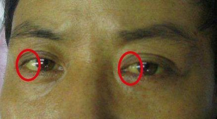 龍魚眼腫脹該怎么治療好：龍魚眼腫脹可能由多種原因引起，治療龍魚眼腫脹需綜合考慮多個因素 龍魚眼腫脹該怎么治療好：龍魚眼腫脹可能由多種原因引起，治療龍魚眼腫脹需綜合考慮多個因素 龍魚百科 第4張
