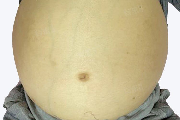 腹水病有哪些治療方法？ 腹水病有哪些治療方法？ 龍魚百科 第6張