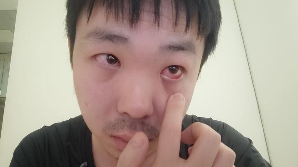 紅眼病多久會自愈？ 紅眼病多久會自愈？ 龍魚百科 第2張