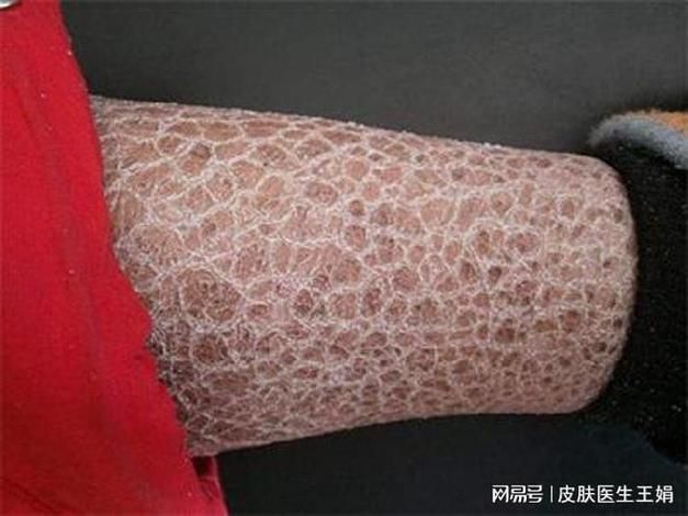 龍魚鱗病圖片對照 龍魚鱗病圖片對照 龍魚百科 第4張