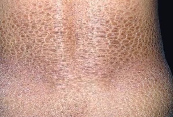 龍魚鱗病圖片對照 龍魚鱗病圖片對照 龍魚百科 第7張