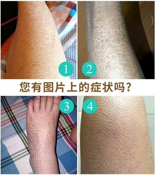 龍魚鱗病圖片對照 龍魚鱗病圖片對照 龍魚百科 第10張