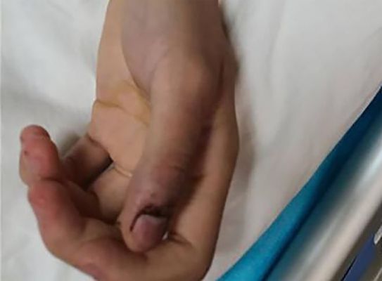 被龍魚咬了會有事嗎會死嗎：被龍魚咬傷怎么辦
