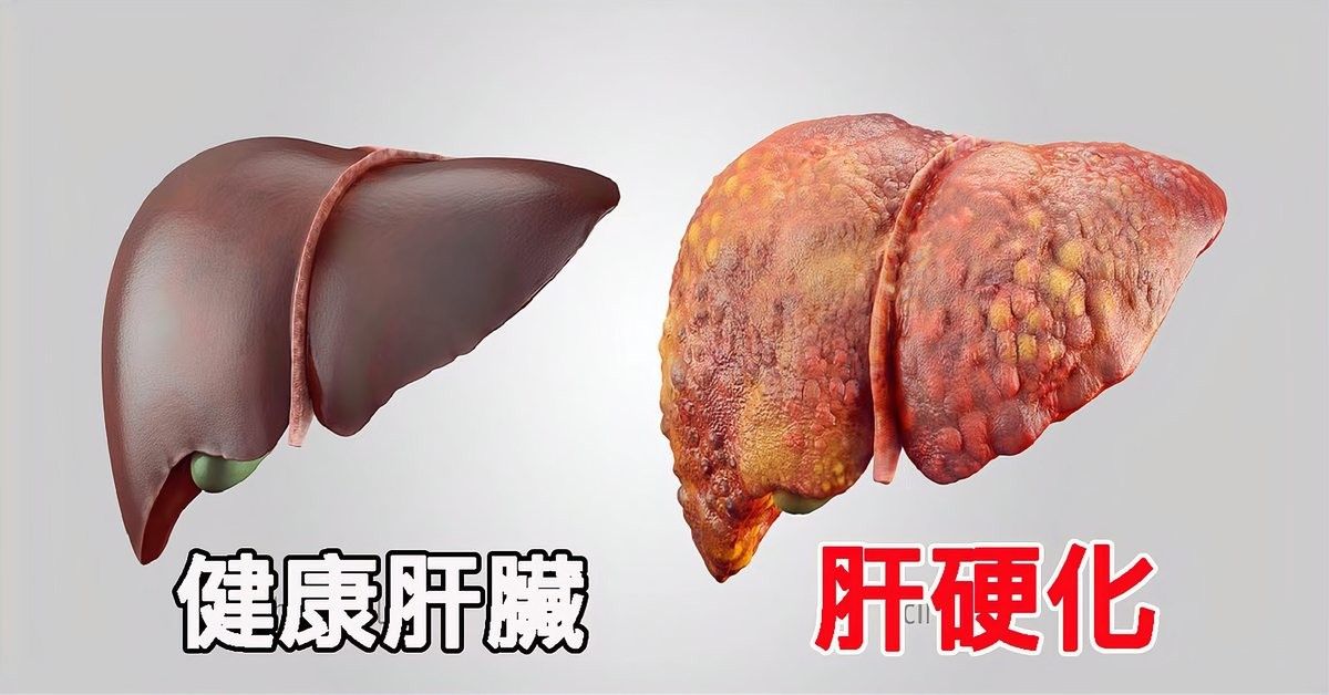 抽腹水后需要復查哪些項目？：抽腹水后需定期復查多項指標