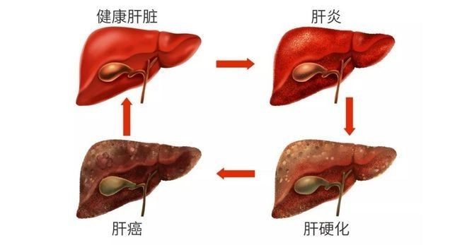 抽腹水后需要復查哪些項目？：抽腹水后需定期復查多項指標