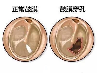 感染型穿孔有哪些癥狀：感染型耳膜穿孔是什么癥狀