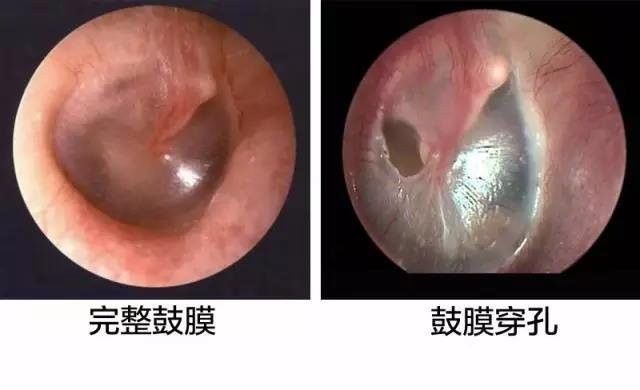 感染型穿孔有哪些癥狀：感染型耳膜穿孔是什么癥狀