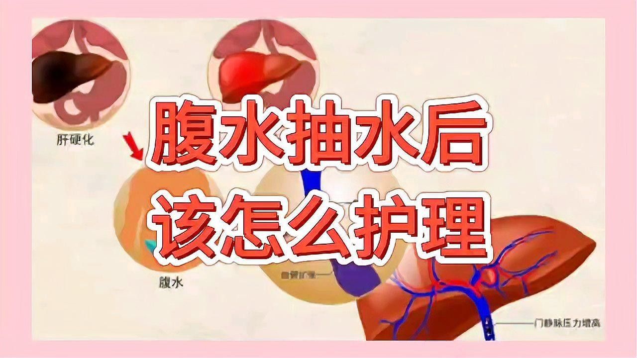 腹水穿刺后多久恢復：腹部穿刺后多久可以恢復