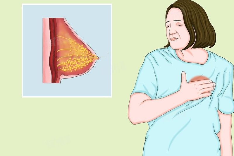 有哪些常見的自檢異常？：乳腺疾病，我們可以自檢嗎