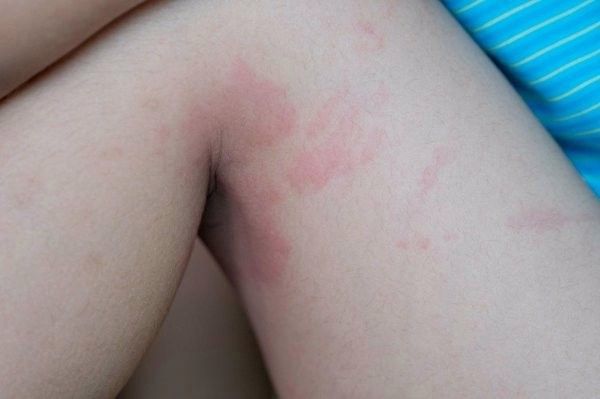 被六角龍魚咬傷會留疤嗎？：六角龍魚咬傷后是否留疤取決于傷口深度、處理方式及個體修復能力