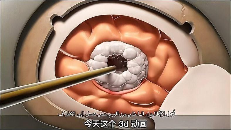 手術(shù)治療風險大嗎？：手術(shù)治療的風險程度因手術(shù)類型、醫(yī)療技術(shù)等因素而異
