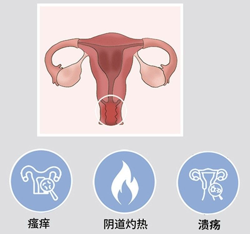 如何預防白霉病的復發？：——預防霉菌性陰道炎怎么預防