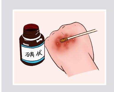 碘伏可以每天使用嗎？：碘伏不建議每天頻繁使用具體需根據傷口情況和醫生建議調整使用頻率