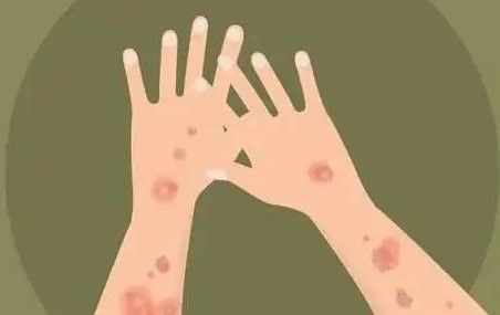 松鱗病能自然緩解嗎？：【健康科普】魚鱗病怎么治療護(hù)理