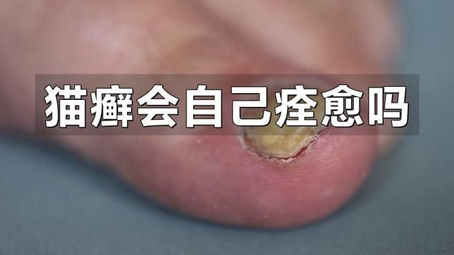 龍貓真菌感染會自愈嗎？：龍貓真菌感染是否能自愈