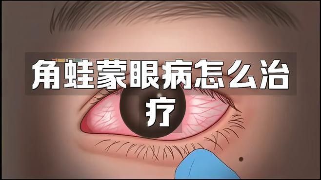 蒙眼病有哪些常見治療方法：蒙眼病治療全攻略