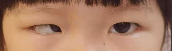 后天形成的鉆石眼如何治療：后天性白內(nèi)障的治療方法