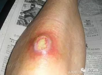 感染后應(yīng)該如何緊急處理：傷口感染了怎么辦
